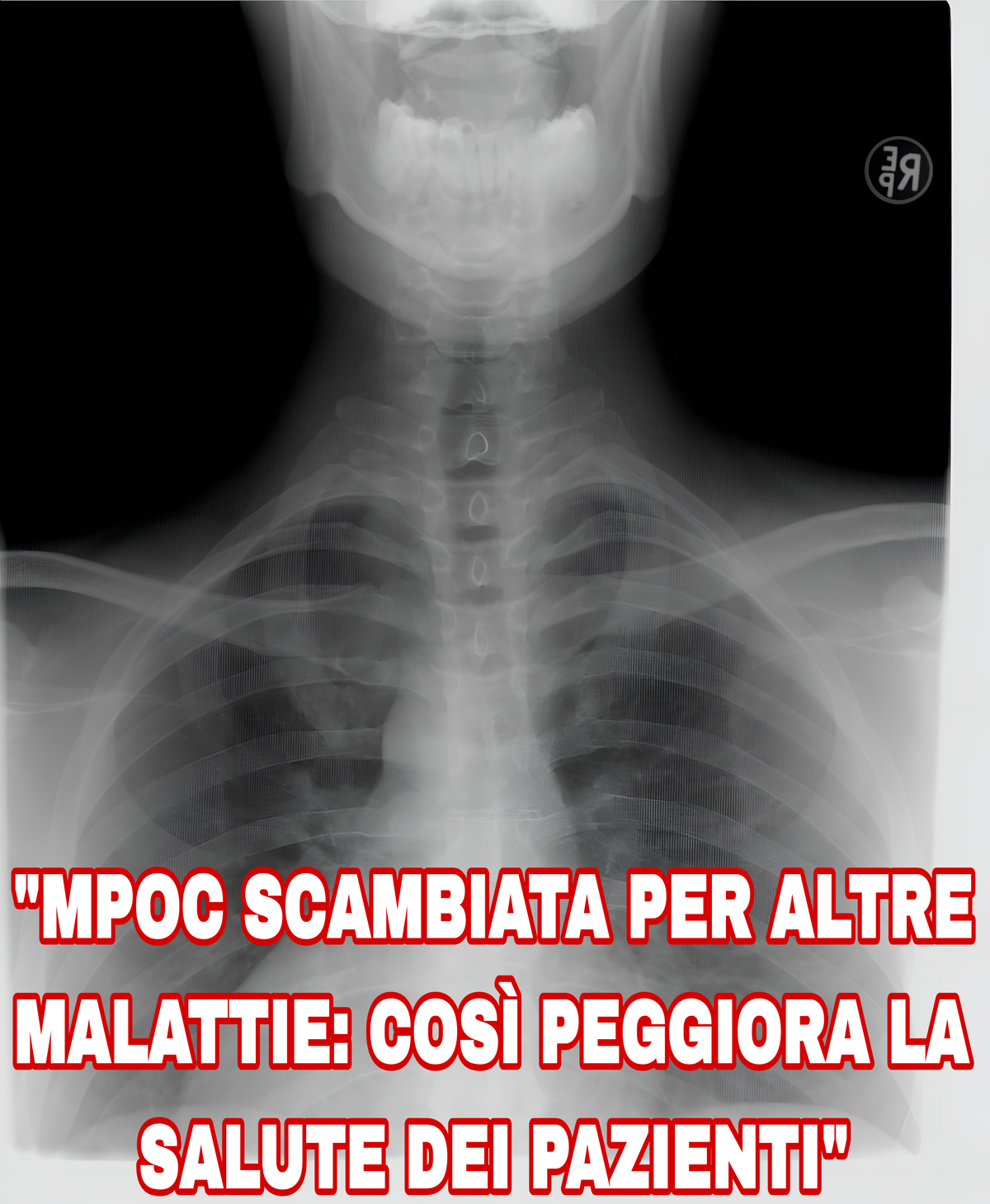 "Malattia polmonare cronica, il pericolo invisibile: serve più attenzione!"