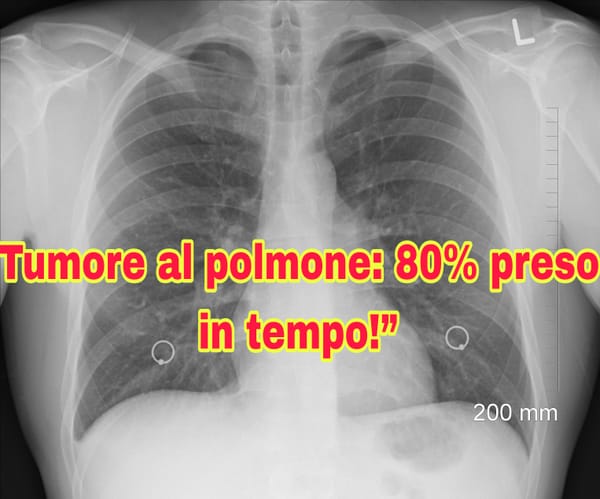 Studio choc: la TAC individua l’80% dei tumori presto! #Tumore #Ricerca