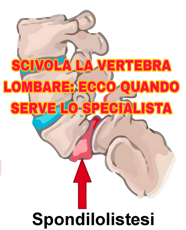 Spondilolistesi lombare: attenzione ai sintomi e ai rischi